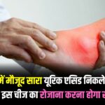 Home Remedy in Uric Acid